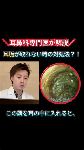 How to deal with earwax that won't come out | ENT doctors soften the earwax before removing it [M...