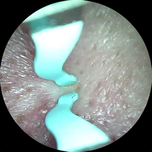 The Best Techniques for Popping Pimples and Blackheads