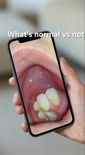 🦷 Tooth Extraction Recovery: What Healing Looks Like