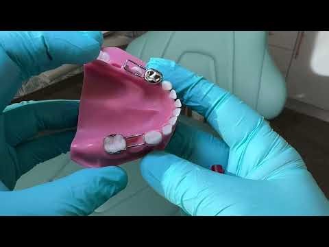 What is a Dental Space Maintainer?