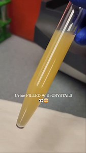 🧪 When your urine is so full of crystals, you can’t see a thing under the scope 😵‍💫 Amorphous crystals are usually found in acidic (urates) urine or alkaline (phosphates) urine and form when urates or phosphates precipitate out of solution as the urine cools. They’re typically either pink (urates) or yellow-brown (phosphates) and give the sediment that “dusty” appearance that can easily obscure everything else on the slide. Clinically, they’re not usually significant, but they can make your l