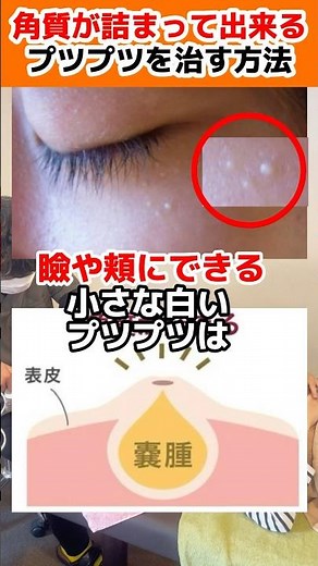 What causes white spots on the surface of the skin?