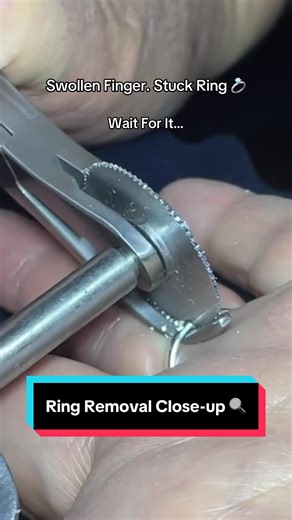 Emergency Ring Removal for Swollen Fingers at Fire Station