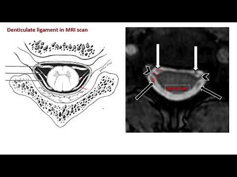 Denticulate ligaments pia mater