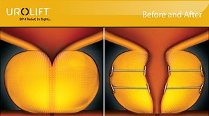 The UroLift® System Treatment | Atlantic Urology Clinics