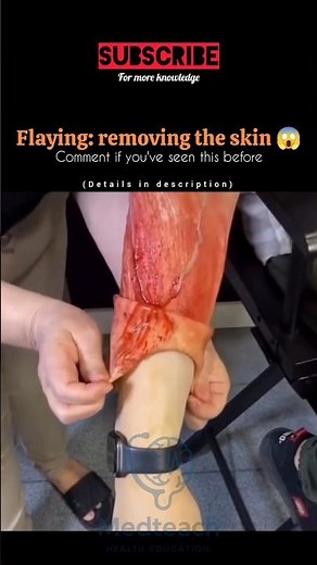 “What Is Flaying? | The Shocking History & Medical Explanation 😳” #youtubeshorts #medicalshorts