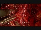 Laparoscopic Radical Prostatectomy • Video • MEDtube.net