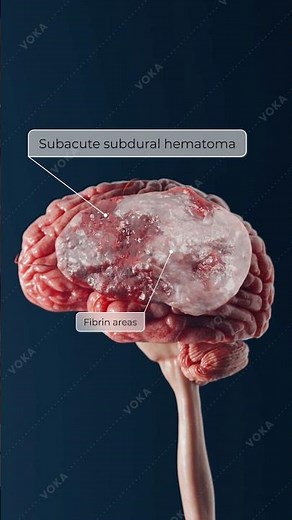 Blood Beneath the Dura: Traumatic Subdural Hematoma in 3D