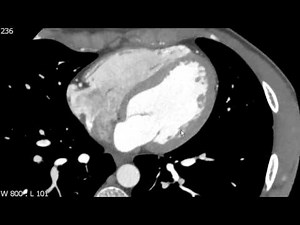 External Features of the Heart on Axial CTA