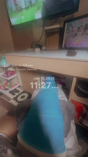 Tibia Fracture Recovery Journey: Day 24 Update