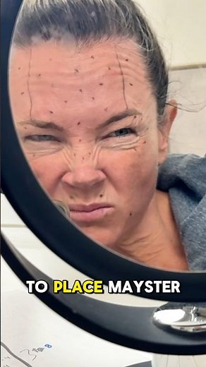 Using Innotox and Mayster PLLA to fix #ozempicface