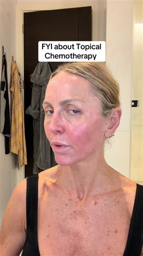 Topical Chemotherapy: 5 Weeks Post-Treatment Update
