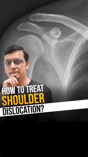 Shoulder dislocation is a common injury, but not all dislocations are the same. The type of dislocation decides the treatment, recovery time, and chances of recurrence. Some cases can be managed with reduction, sling support, and physiotherapy, while others—especially recurrent or complex injuries—may need surgical intervention. Early diagnosis and proper rehabilitation are key to preventing long-term shoulder instability. Timely treatment helps restore movement and avoid repeat injuries. ⚠️ Dis