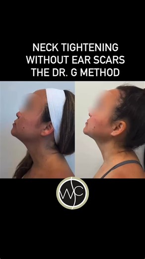 Imagine looking down at your phone without creating neck folds. She can — and you can too. Smoother lines, tighter contours, effortless confidence. No scars around the ears, no general anesthesia. #gstitch @renuvion #surgylift #TechNeckFix #NeckSculpting #DrGMethod | West Coast Plastic Surgery Center | Facebook