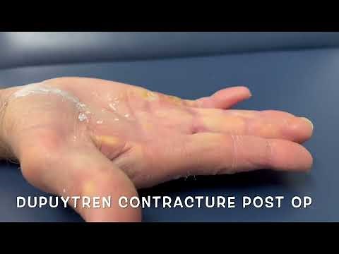 Dupuytren's disease finger contracture surgery before and after