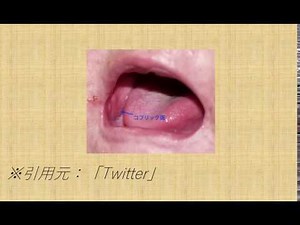 コプリック斑がみられる疾患はどれか？？【必修】