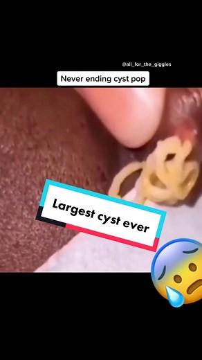 Never wnding cyst extraction. #oddlysatisfying #blackheads #dilatedpore #cystexplosion #blackheadextractions #satisfyingvideo #cheesetax