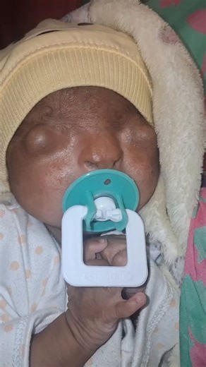 This video shows a baby with cryptophthalmos, a rare condition where a baby is born without eyelid openings.Types: complete (no eyelids at all), incomplete (partly formed), abortive (eyelid stuck to eyeball)What causes it? The tissues in the face do not separate properly while the baby is growing in the womb. This is usually due to genes passed down from parents or random changes in genes.Things that can increase the risk:A family history of the same conditionParents who are blood relatives (lik