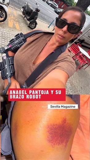 Sevilla Magazine | #IMAGEN Ha cambiado su escayola por un "brazo robot" que, según le han dicho los médicos, es fundamental para su recuperación. Anabel... | Instagram