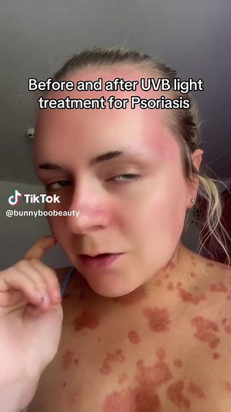 Effective UVB Light Treatment for Psoriasis Results