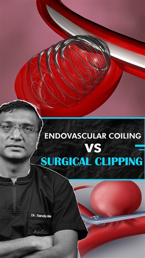 Dr Sandip Mavani on Instagram: "Endovascular coiling vs surgical clipping! Endovascular coiling and surgical clipping are two procedures used to treat brain aneurysms and prevent rupture. Coiling is a minimally invasive approach where a catheter is guided through blood vessels to place platinum coils inside the aneurysm, promoting clotting and sealing it off. Clipping, on the other hand, is an open brain surgery where a metal clip is placed at the aneurysm’s base to stop blood flow. While coilin