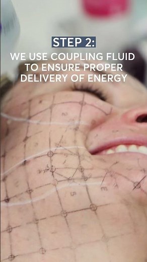 Thermage Treatment: What is it and How Does it Work?