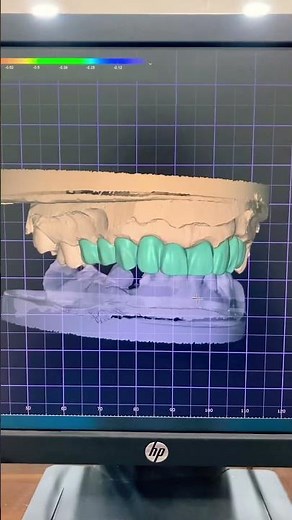 Screen recording of a real Exocad workflow. No commentary (teaser)