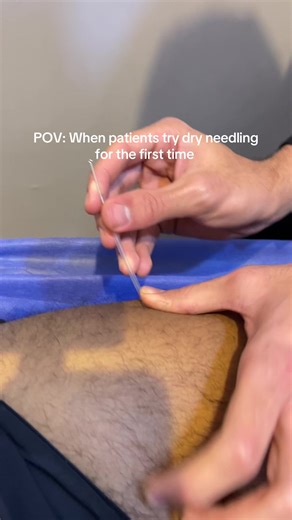 Understanding Dry Needling: First-Time Patient Experience