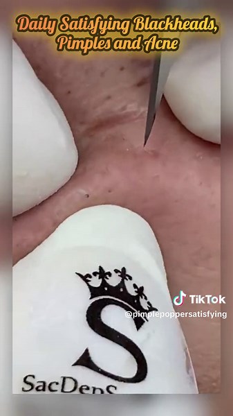 BEAUTIFUL EXTRACTION #pimplepoppersatisfying #pimple #blackhead