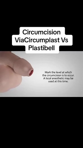 Comparing Circumcision Methods: Circumplast Vs Plastibell