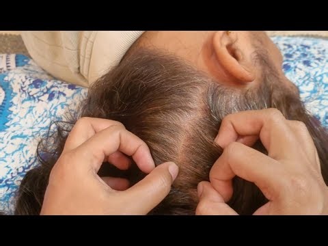 ✨ ASMR ✨ Intense Lice Check & Hair Pulling For Instant Sleep 💤😴 ( Real Person)