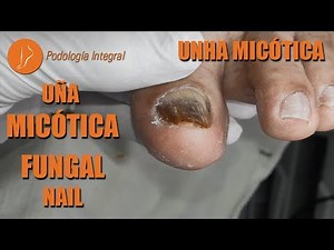 Uña micótica - Fungal nail - Unha micótica [Podología Integral]