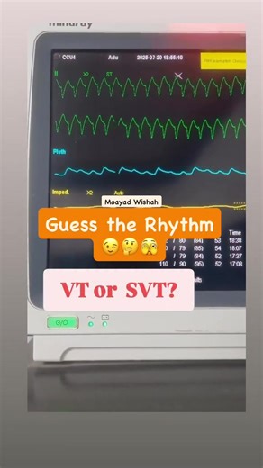 Understanding SVT in Critical Care Simulation