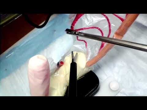 "Appy-Ready" DIY Laparoscopic Appendectomy Simulator