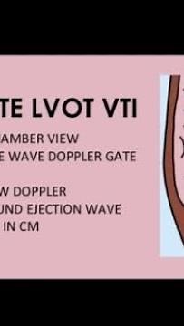The aortic velocity time integral (VTI) #medical #medicine #education #shorts #like #educational