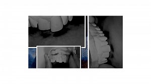 Bite marks led to wrongful conviction