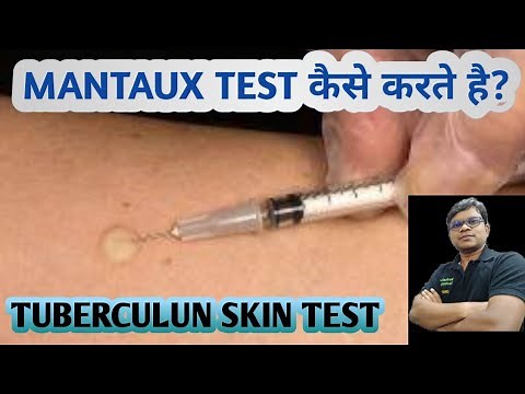 Mantoux test | TST | PPD | Tuberculin skin test | Diagnosis of TB.