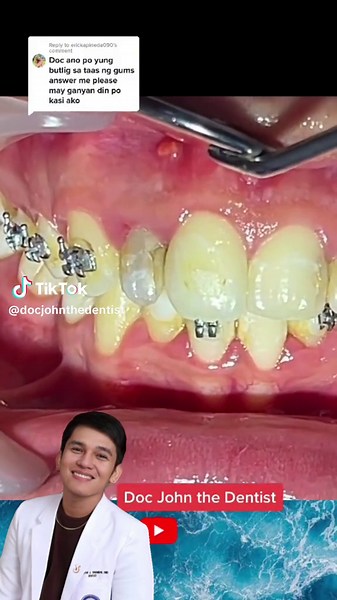 Tooth Abscess Symptoms and Treatment