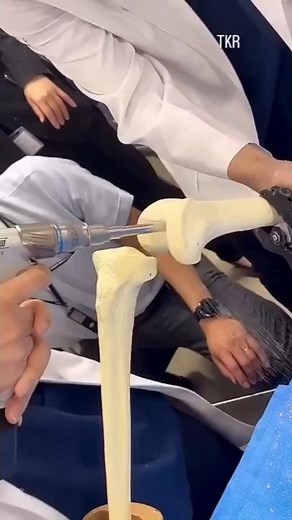 Total Knee Replacement: Watch the FULL Surgery Process