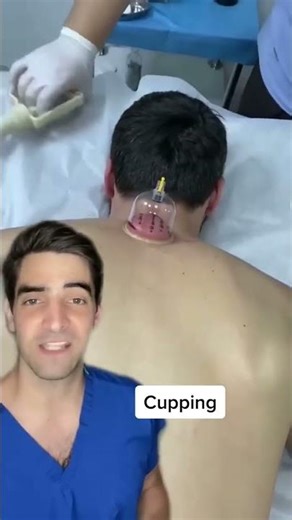 "Why Do Athletes Use Cupping? (The Science of the Purple Marks)"