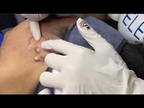 Big Cystic Acne Blackheads Extraction Blackheads & Milia, Whiteheads Removal Pimple Popping