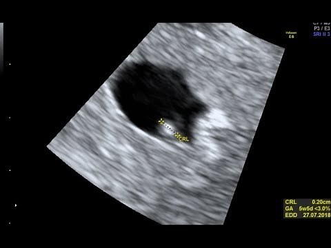 5 Weeks 5 Days Ultrasound