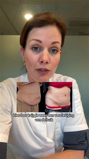Velthuis kliniek on Instagram: "Een prachtig resultaat van een buikwandcorrectie en liposuctie. ✨ Plastisch chirurg Carlijn Schipper licht toe hoe zij deze behandeling heeft aangepakt en welke stappen hebben geleid tot dit mooie eindresultaat. Wil je weten wat deze behandeling voor jóu kan betekenen? Plan een consult in en laat je adviseren door onze specialisten. 🙌 #buikwandcorrectie #liposuctie #velthuiskliniek #plastischchirurgie #beforeandafter"