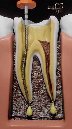 6.4K views · 15 reactions | ROOT CANAL TREATMENTENT 醴 When a tooth...