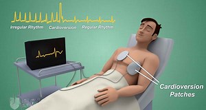 Cardioversion procedure, types, risks, complications and success rate