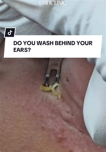 Spot extraction behind the ear ✨ A satisfying extraction of a stubborn congestion hidden in the postauricular (behind-the-ear) area. These spots can often go unnoticed and may build up over time. The area was thoroughly cleansed before and after extraction to help promote healthy, clear skin. ⚠️ Individual results may vary. Professional assessment is recommended before any treatment. #ExtractionFacial #BlackheadRemoval #extractionsatisfaciton #extraction #londonskin