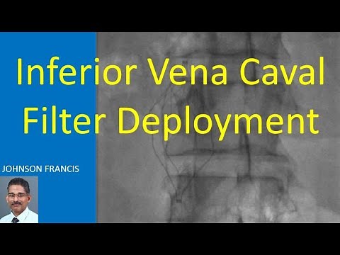 Inferior Vena Caval Filter Deployment