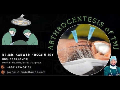 Arthrocentesis of TMJ