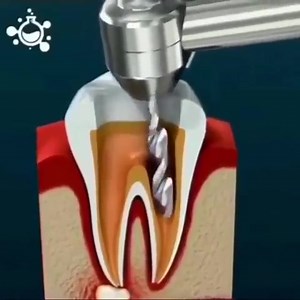 Animated Root 🦷Canal Treatment by @dental_illustration Root canal treatment is a treatment sequence for the infected pulp of a tooth which is intended to result in the elimination of infection and the protection of the decontaminated tooth from future microbial invasion. Tag someone | Dentistry blog