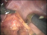Robotic Total Mesorectal Excision - Marecik Et Al.  • Video • MEDtube.net
